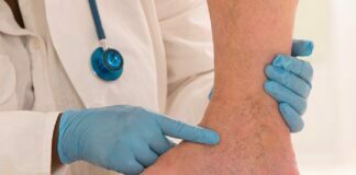 How Can Thread Veins Be Prevented? Thread Veins