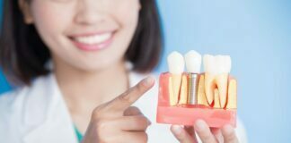 Important Facts about Dental Implants Important Facts about Dental Implants