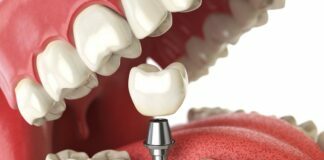 The Basics of Dental Implants Dental Implants