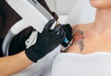 Factors that Affect the Cost of Tattoo Removal Tattoo Removal