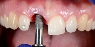Is There Any Practical Way to Save Knocked-out Teeth? Teeth