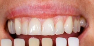 Rebuilding Your Smile Using Porcelain Dental Veneers Dental Veneers