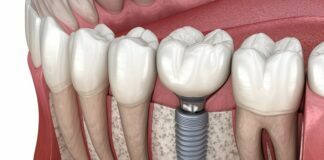 The Benefits of Dental Implants Over Traditional Dentures Dental Implants