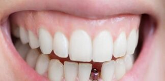 The Pros and Cons of Dental Implants: Is It Right for You? Dental Implants
